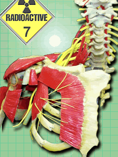 radiation fibrosis of brachial plexus