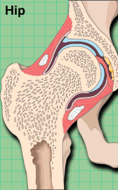 necrosis of the bone - hip