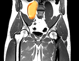 MRI of kidney area